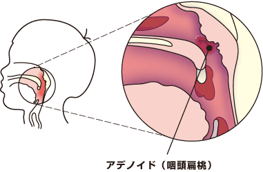 アデノイド