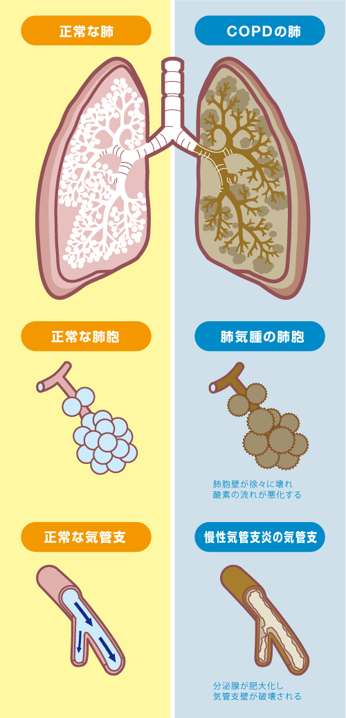 copd と 肺気腫 の 違い