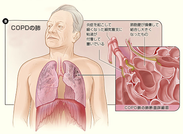 image_b 図B:COPD患者の肺と肺胞